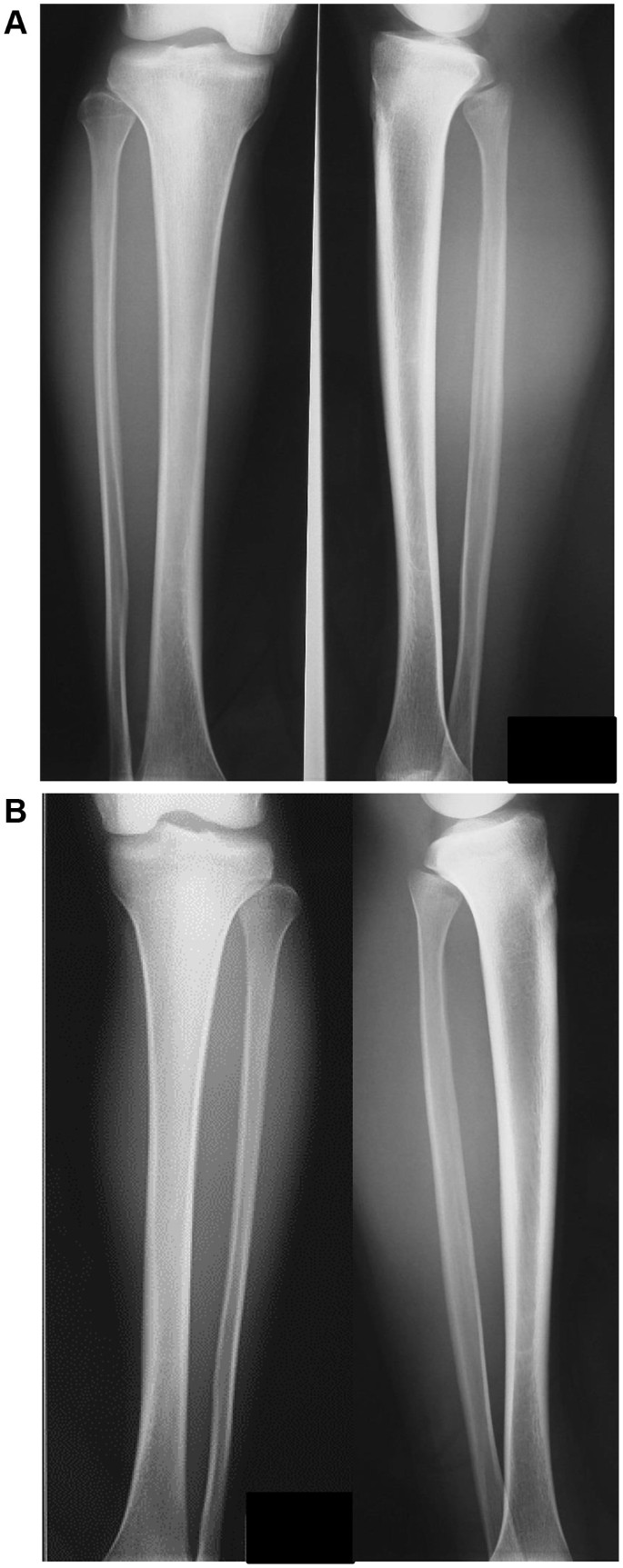 vertraging Tegenslag Glans A complete posterior tibial stress fracture that occurred during a  middle-distance running race: a case report | SpringerLink
