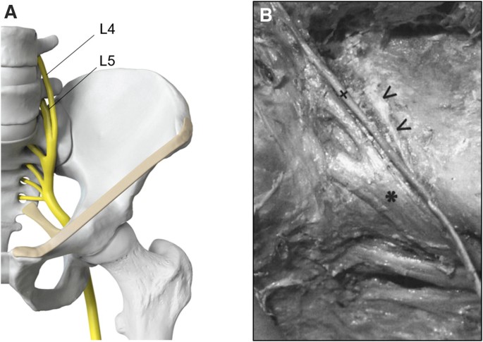 Direct anterior decompression of L4 and L5 nerve root in sacral  