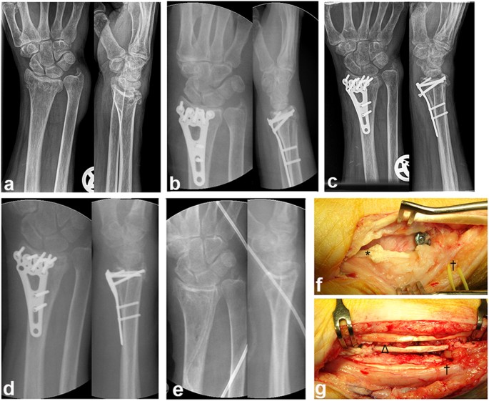 Complications After Operatively Treated Distal Radius Fractures |  Springerlink