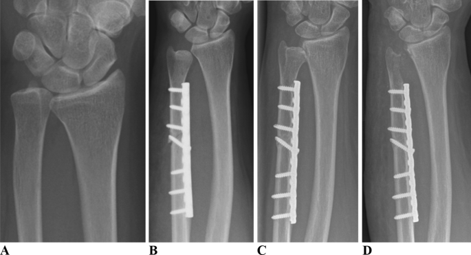 Ulnar shortening osteotomy as a treatment of symptomatic ulnar impaction  syndrome after malunited distal radius fractures | SpringerLink