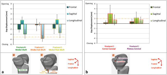 The effect of coronal splits on the structural stability of bi-condylar  tibial plateau fractures: a biomechanical investigation | SpringerLink