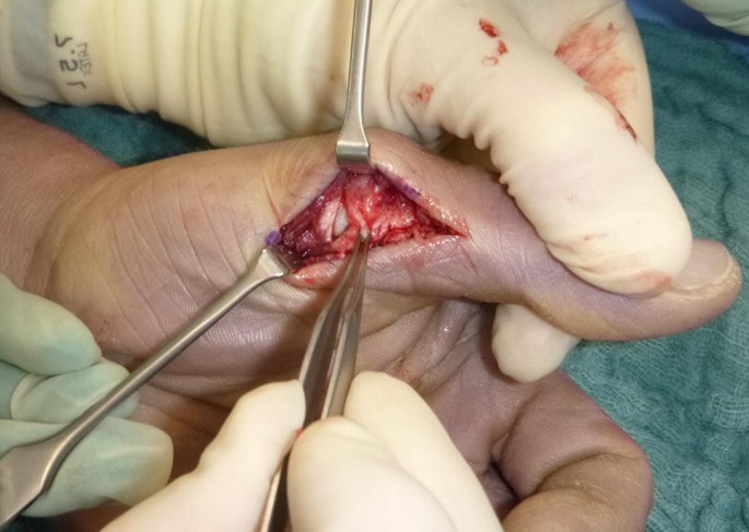 Guardians 3B Ramírez has thumb surgery to repair ligament