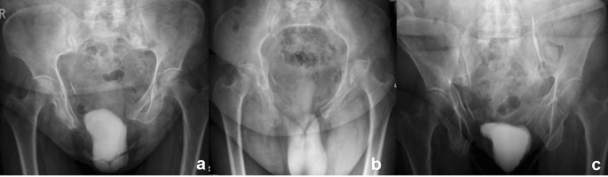 What are open book pelvic fractures?