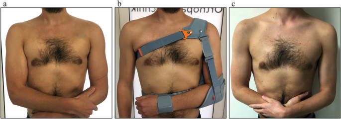 Almindelig George Stevenson Arbejdskraft Can an acute high-grade acromioclavicular joint separation be reduced and  stabilized without surgery? A surgeon's experience – Sogacot