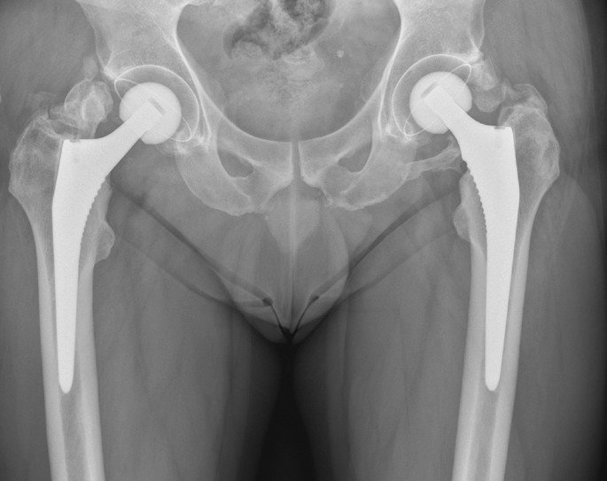 Total hip replacement, Radiology Case