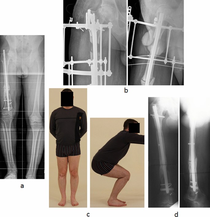 The outcomes of Ilizarov treatment in aseptic nonunions of the tibia  stratified by treatment strategies and surgical techniques