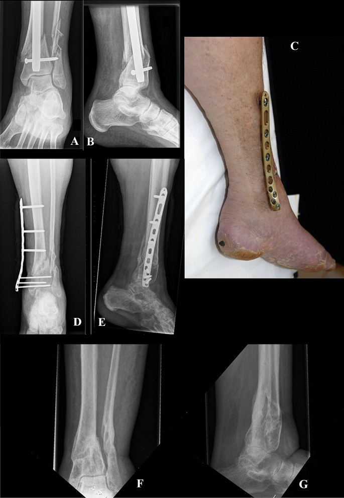 Analysis of bone transport for ankle arthrodesis as a limb salvage  procedure for the treatment of septic pilon fracture nonunion