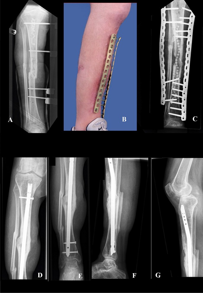 Analysis of bone transport for ankle arthrodesis as a limb salvage  procedure for the treatment of septic pilon fracture nonunion