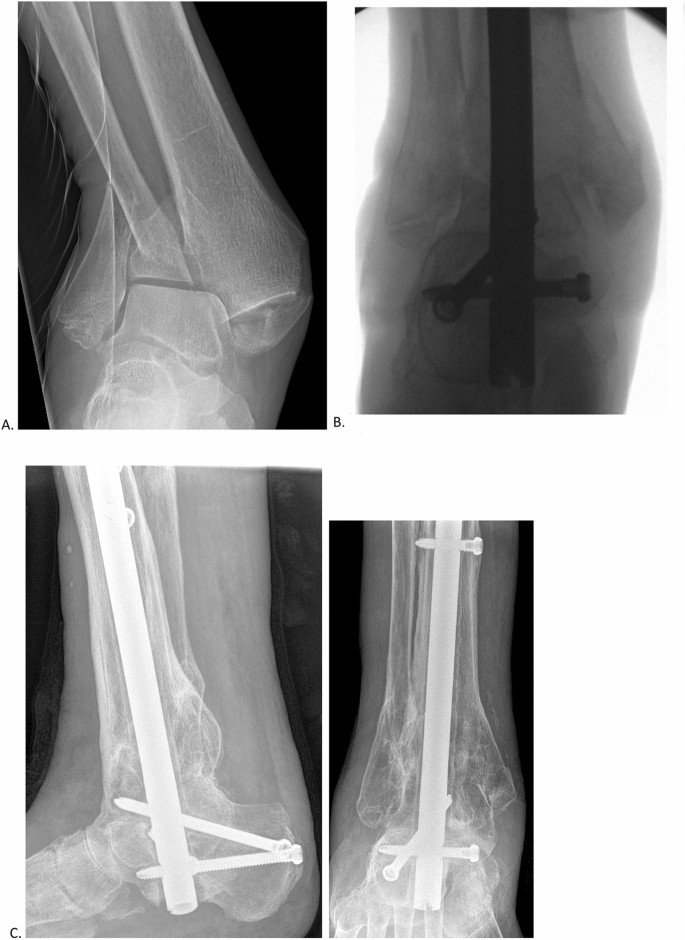 High-risk ankle fractures in high-risk older patients: to fix or nail? |  SpringerLink