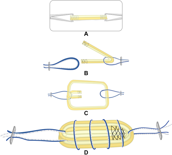 Single bundle hamstrings autograft preparation techniques for anterior