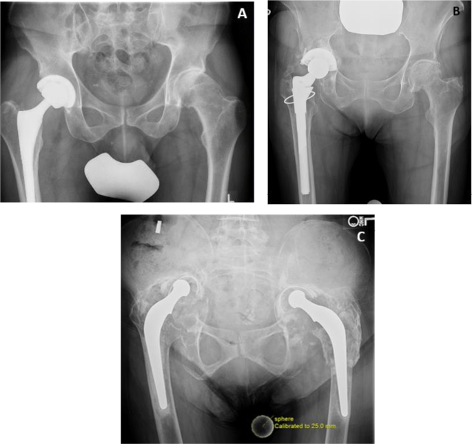 Reliability and validity of the Paprosky classification for acetabular ...