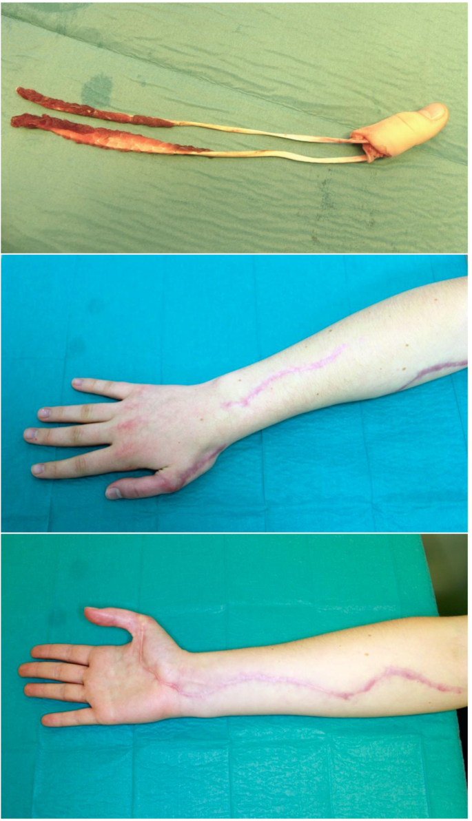 Equestrian-associated injuries of the hand: a retrospective analysis of ...