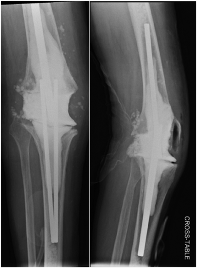 Static Side Rods Threaded rods versus arthrodesis nail as a static spacer for two-stage ...