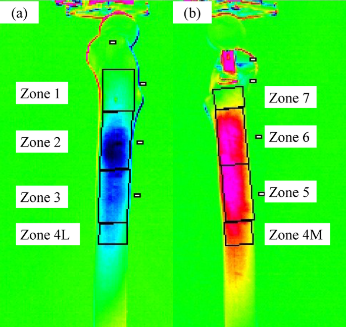 Femoral stress distribution in fully hydroxyapatite-coated cementless ...