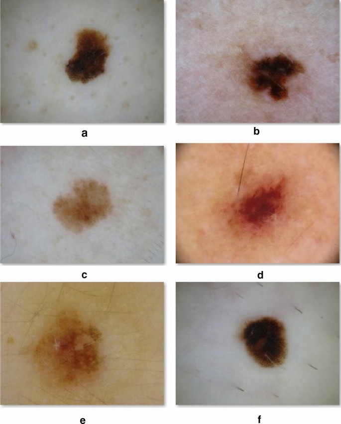 Dermoscopy of early melanomas: variation according to the anatomic site |  SpringerLink