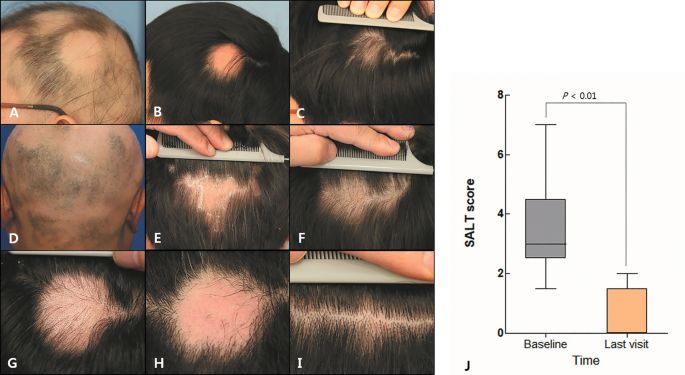 IPAL Clinic  Hair treatment One Session only 30 to 40mins Regenera  Activa  Fibroblast stem cells therapy the most effective hair loss  treatment yet It is purely natural without any harmful