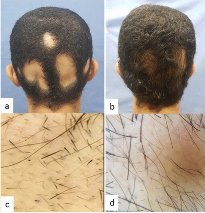 Evaluation of fractional carbon dioxide laser alone versus its combination  with betamethasone valerate in treatment of alopecia areata, a clinical and  dermoscopic study | SpringerLink