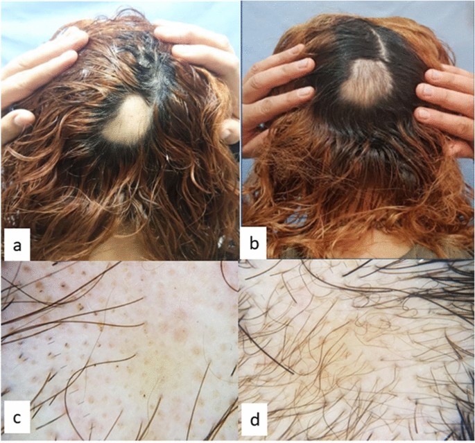 Evaluation of fractional carbon dioxide laser alone versus its combination  with betamethasone valerate in treatment of alopecia areata, a clinical and  dermoscopic study | SpringerLink