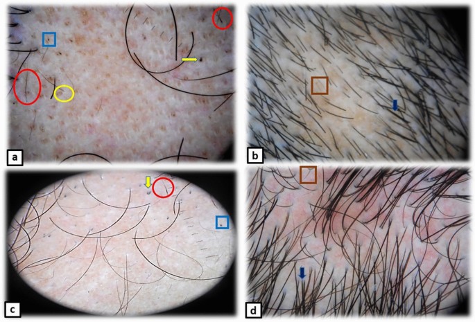 Fractional carbon dioxide laser alone and as an assisted drug delivery for  treatment of alopecia areata: a clinical, dermoscopic and  immunohistochemical study | SpringerLink