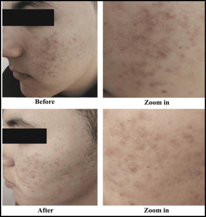 Efficacy and safety of topical spironolactone versus topical dapsone in ...