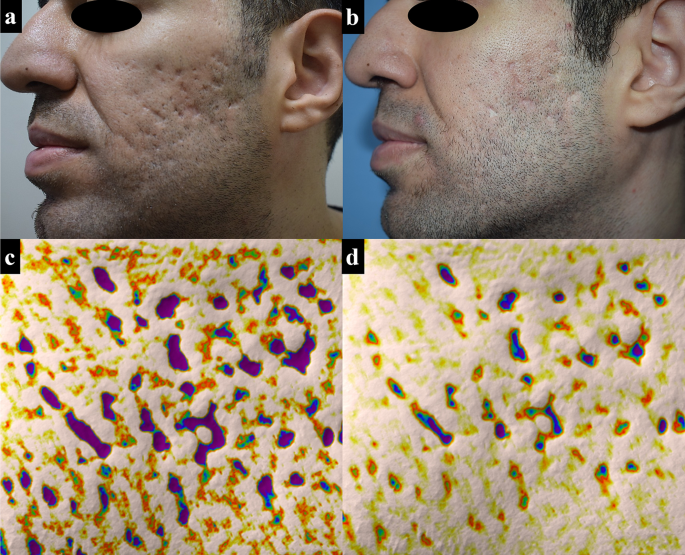Subcision Thread PDO screw threads versus fractional CO2 laser, after subcision, for ...