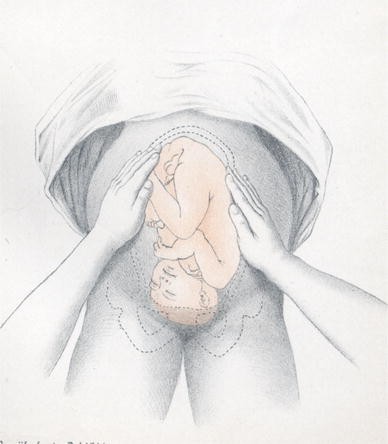 Evaluation Of Sharma S Modified Leopold S Maneuvers A New Method For Fetal Palpation In Late Pregnancy Springerlink