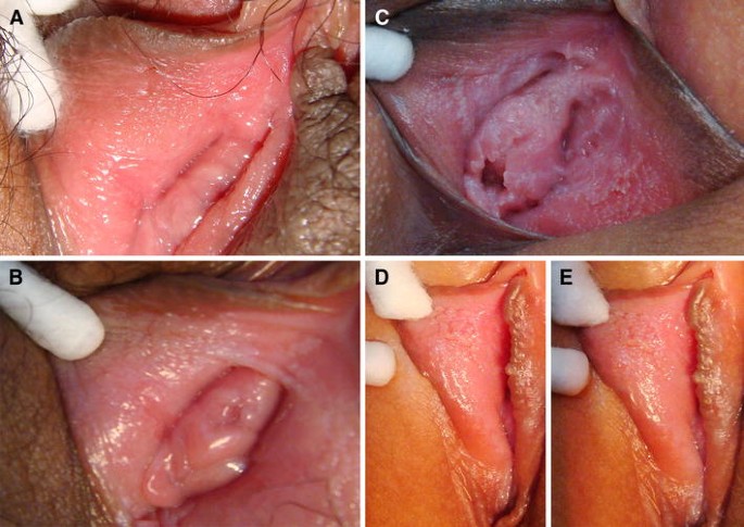condyloma around urethra