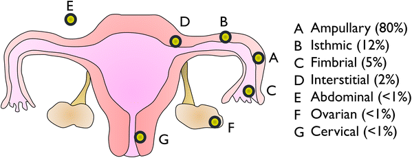 Nontubal ectopic pregnancy