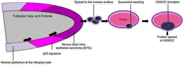 ovarian cancer epithelial origin hpv vaccine skin reaction