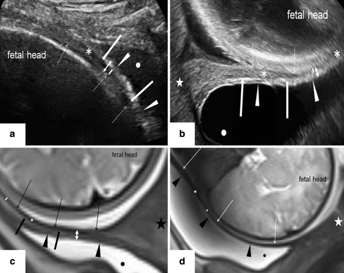 Cesarean section scar in 3 T magnetic resonance imaging and ultrasound:  image characteristics and comparison of the methods | SpringerLink