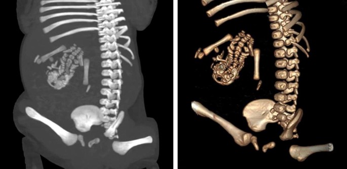 Fetus-in-fetu: a rare condition that requires common rules for its ...