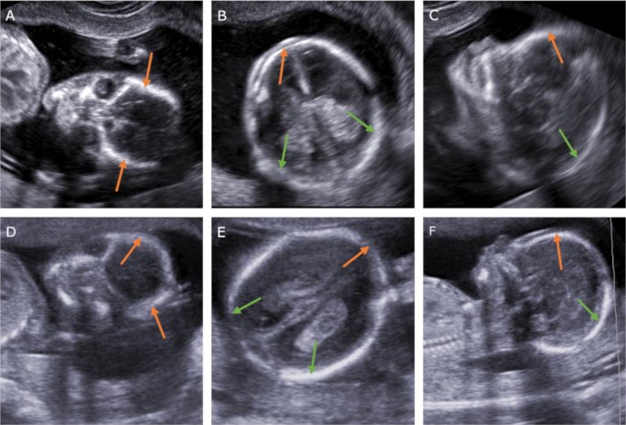 The Role Of The Beret Sign And Other Markers In Ultrasound Diagnostic Of The Acrania Exencephaly Anencephaly Sequence Stages Springerlink