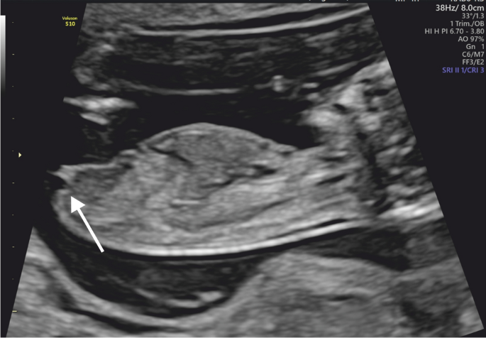 Clinical Spectrum Of Female Genital Malformations In Prenatal Diagnosis Springerlink