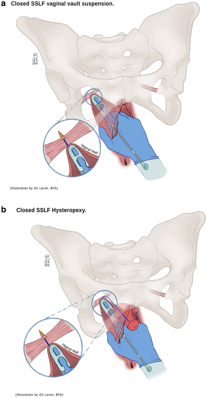 Sacrospinous ligament fixation (SSLF): an old method with new horizons |  SpringerLink