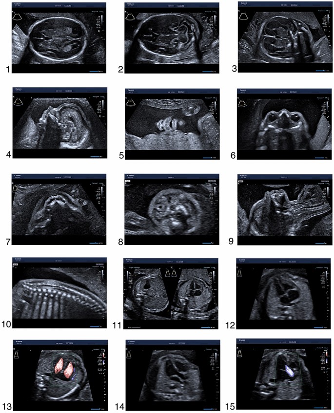 How to do a second trimester anomaly scan | SpringerLink