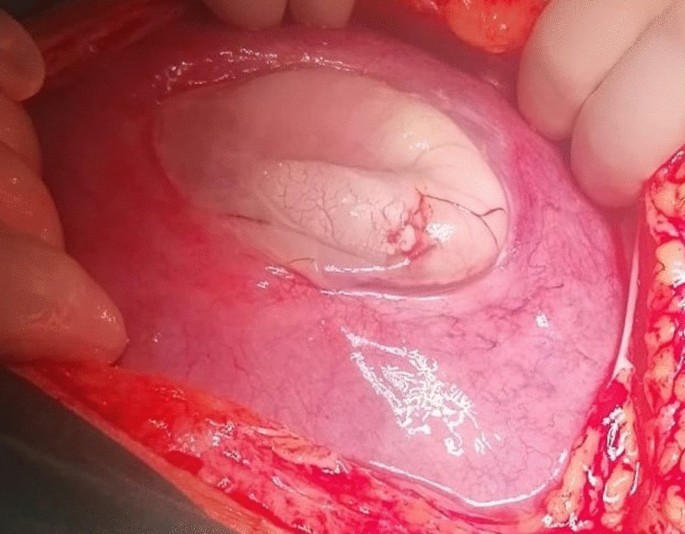 Silent fundal pre-labor term scar uterine rupture after corporeal cesarean  section | Archives of Gynecology and Obstetrics