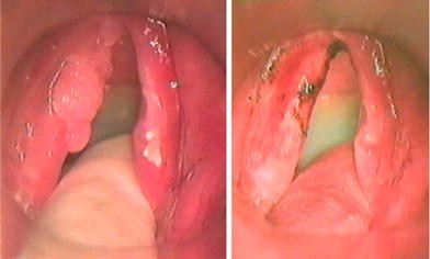 treatment of laryngeal papillomatosis with cidofovir