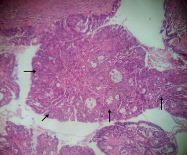 ductal papilloma of salivary gland