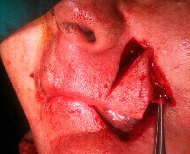 Lower Lip Reconstruction With Abbe Estlander Flap Modification Preserving The Same Side Vascular Pedicle Springerlink