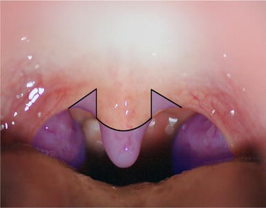 Treatment of obstructive sleep apnea syndrome using radiofrequency-assisted  uvulopalatoplasty with tonsillectomy | SpringerLink