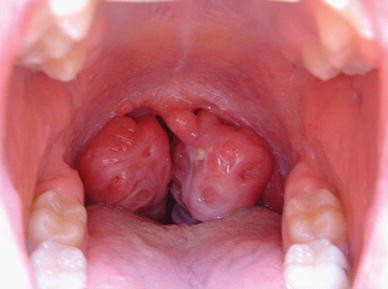 tonsillar hypertrophy score