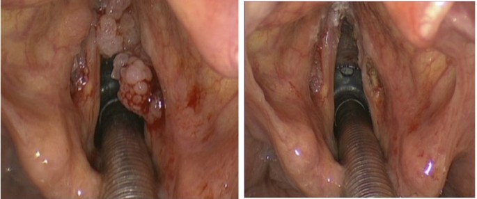 coblation laryngeal papilloma îndepărtarea condiloamelor și a negilor