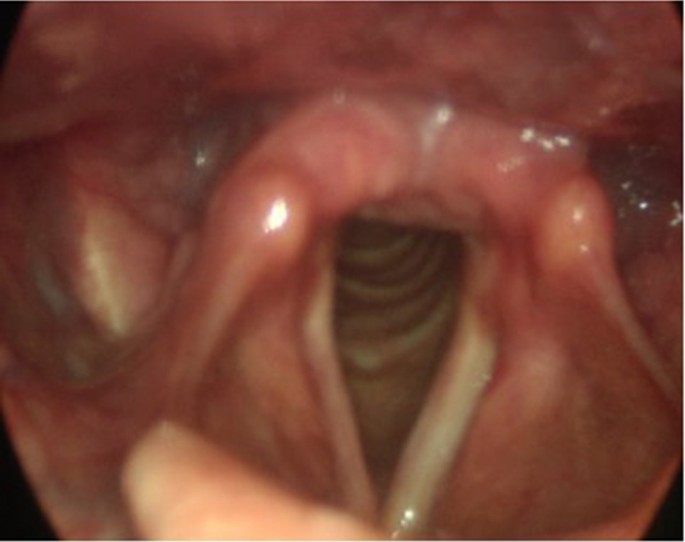 laryngeal papilloma anaesthesia)