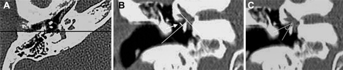 Stapes prosthesis dislocation - Siemens Healthineers USA