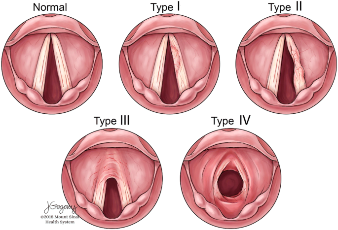 Vocal fold scars: a common classification proposal by the American  Laryngological Association and European Laryngological Society |  SpringerLink