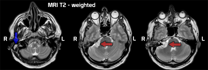 Cholesteatoma Radiology Reference Article Radiopaedia Org