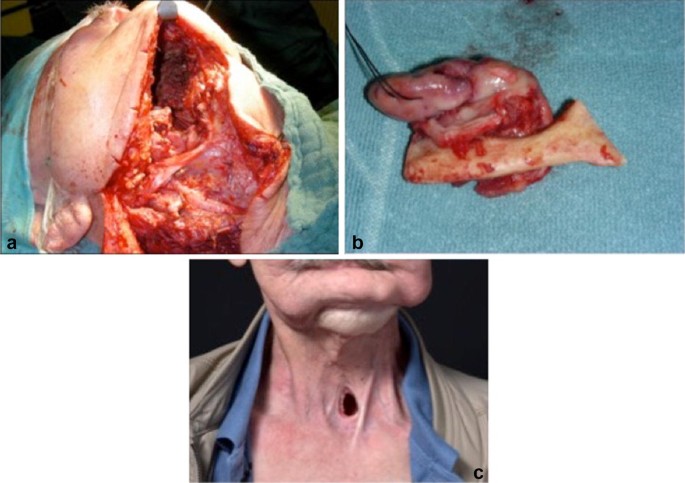 radical neck dissection post op