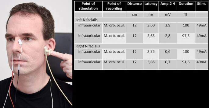 Facial Nerve Electrodiagnostics For Patients With Facial Palsy A Clinical Practice Guideline Springerlink