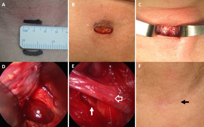 minimally invasive parathyroidectomy