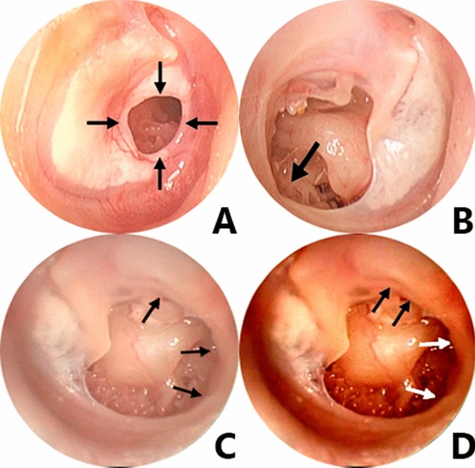 Tympanic membrane perforations: a critical analysis of 1003 ears and  proposal of a new classification based on pathogenesis | SpringerLink